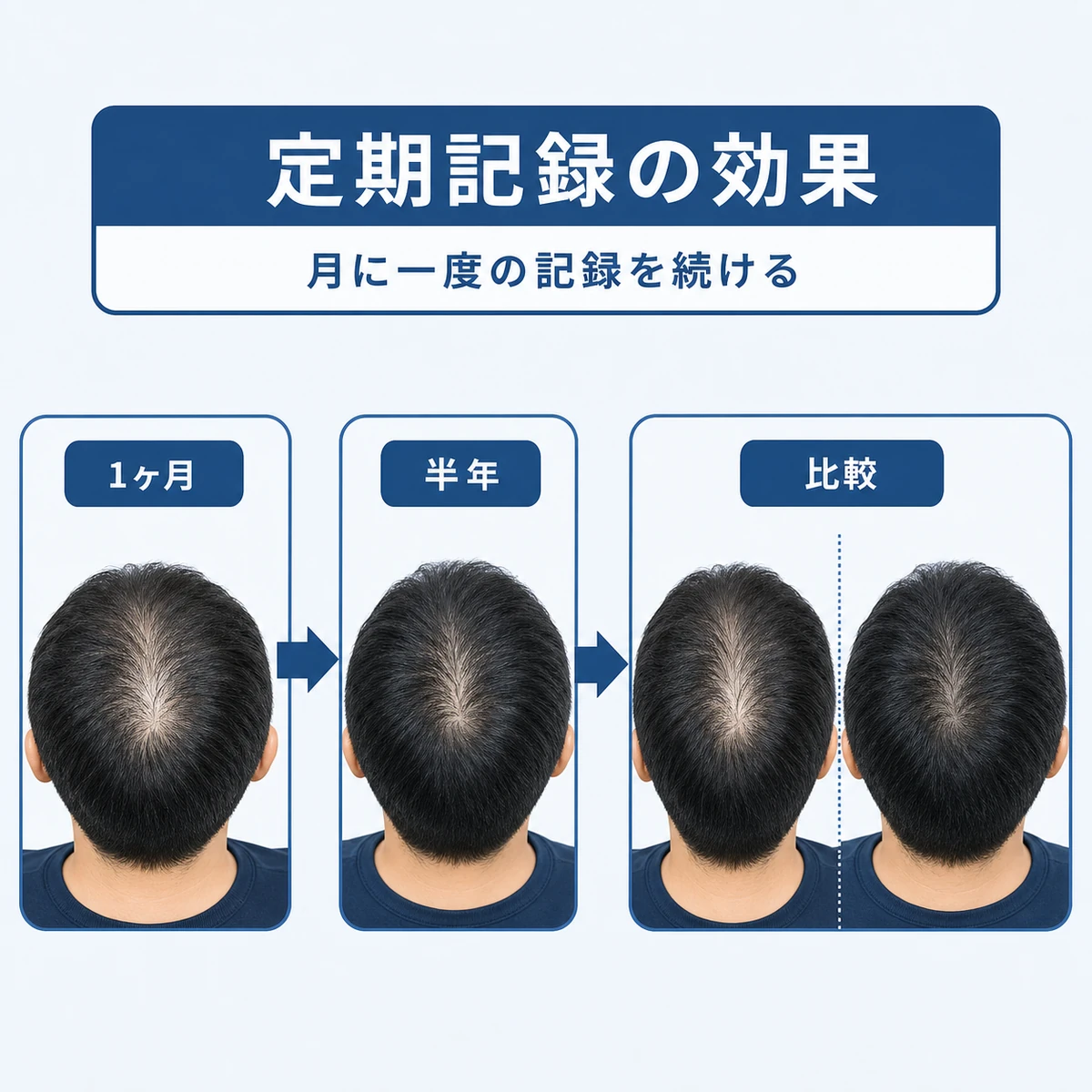 毎月の頭頂部撮影を時系列で並べて比較する定期記録の流れを描いた医療イラスト