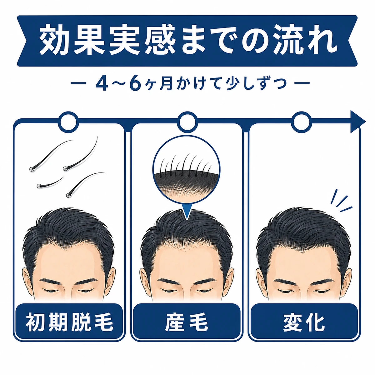 ミノキシジルで生え際に効果が現れるまでの期間の流れを表した医療イラスト