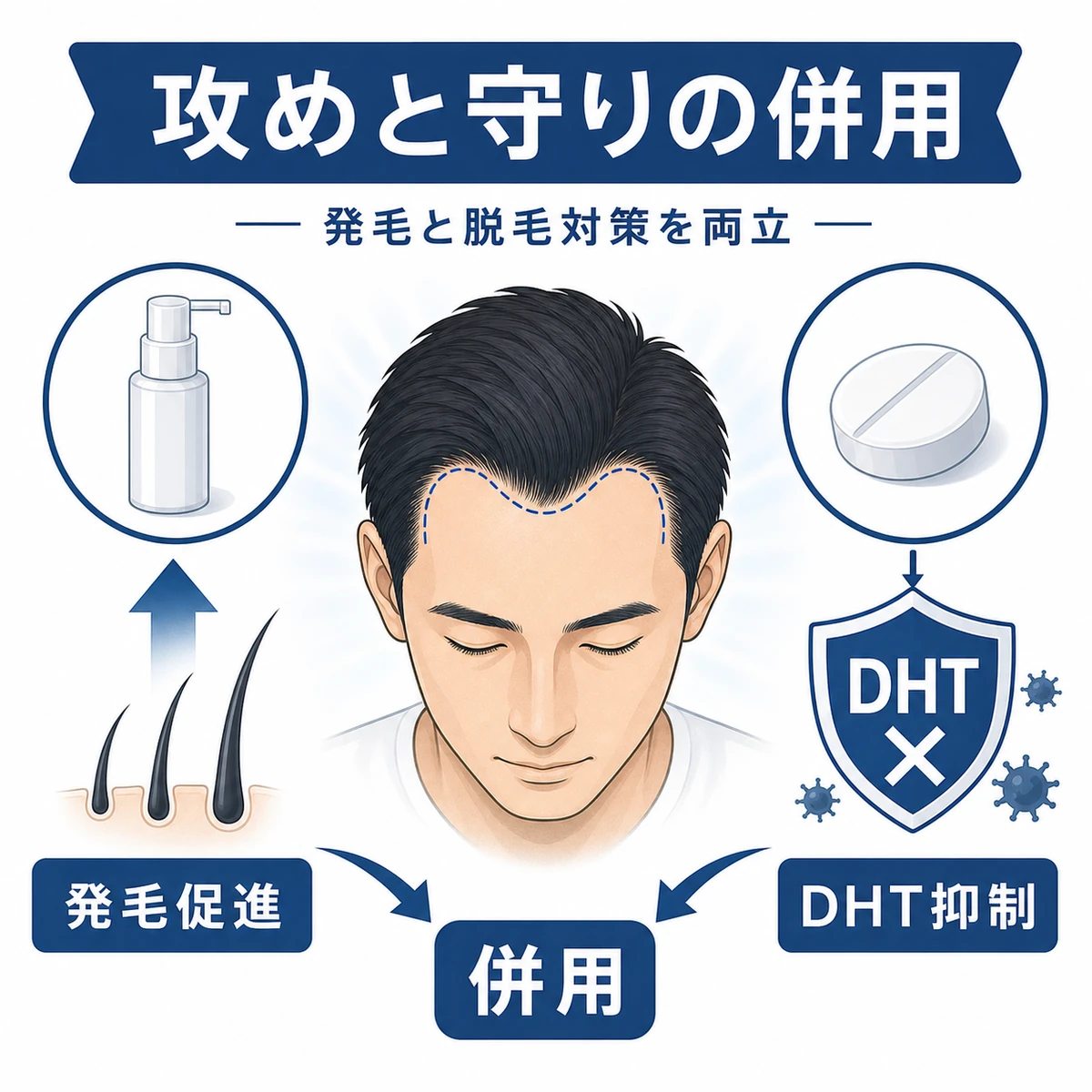 ミノキシジルと内服薬の併用でM字はげに働きかける組み合わせを表した医療イラスト