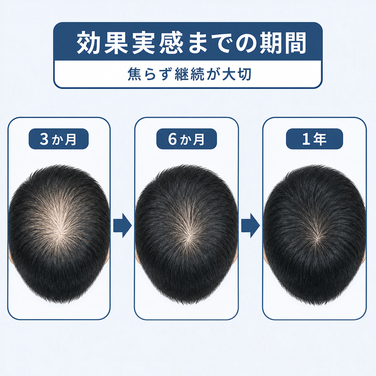 ミノキシジル使用後の頭頂部の変化を3か月・6か月・1年の流れで示した医療イラスト