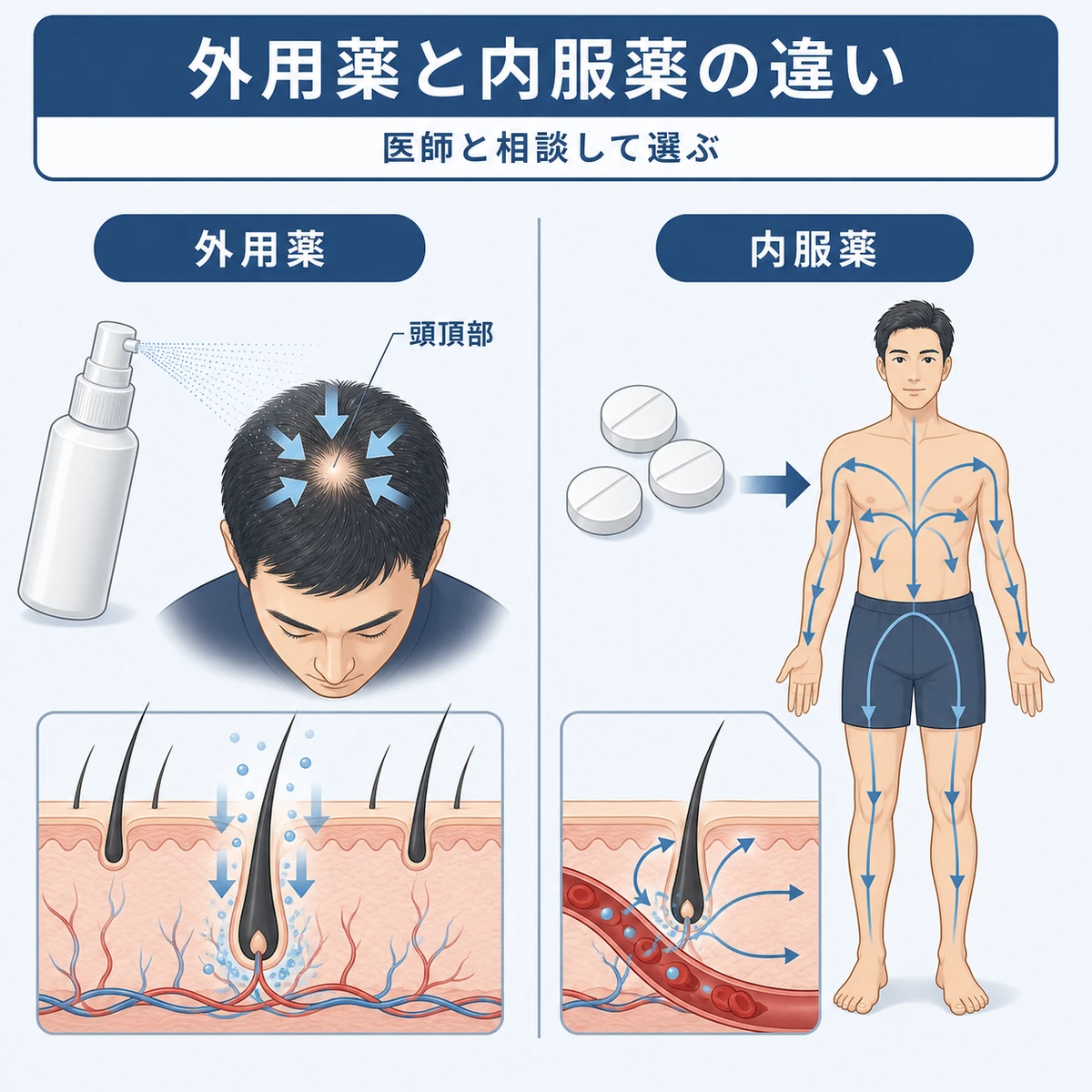 ミノキシジルの外用薬と内服薬の特徴を比べた医療イラスト