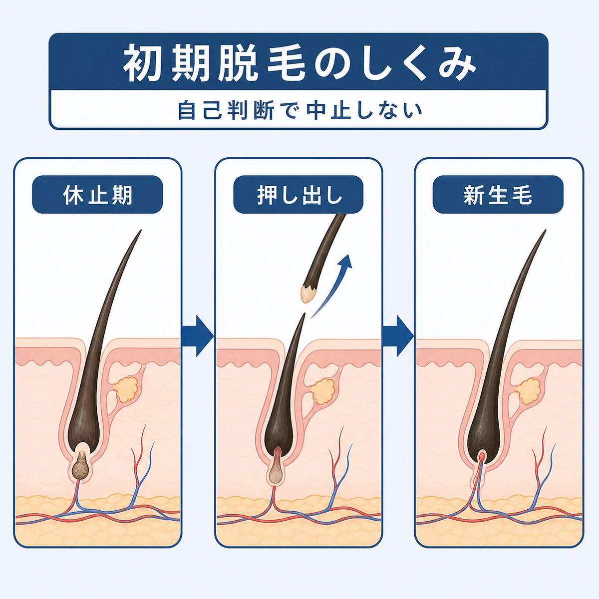 初期脱毛で古い毛が抜け新しい毛が生えるヘアサイクルの流れを表した医療イラスト