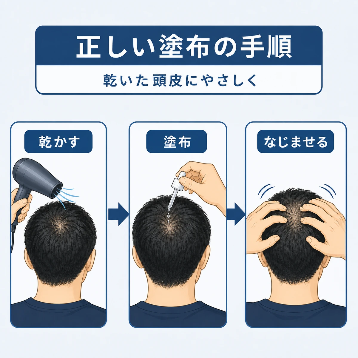ミノキシジル外用薬を頭頂部に塗布する正しい手順を表した医療イラスト