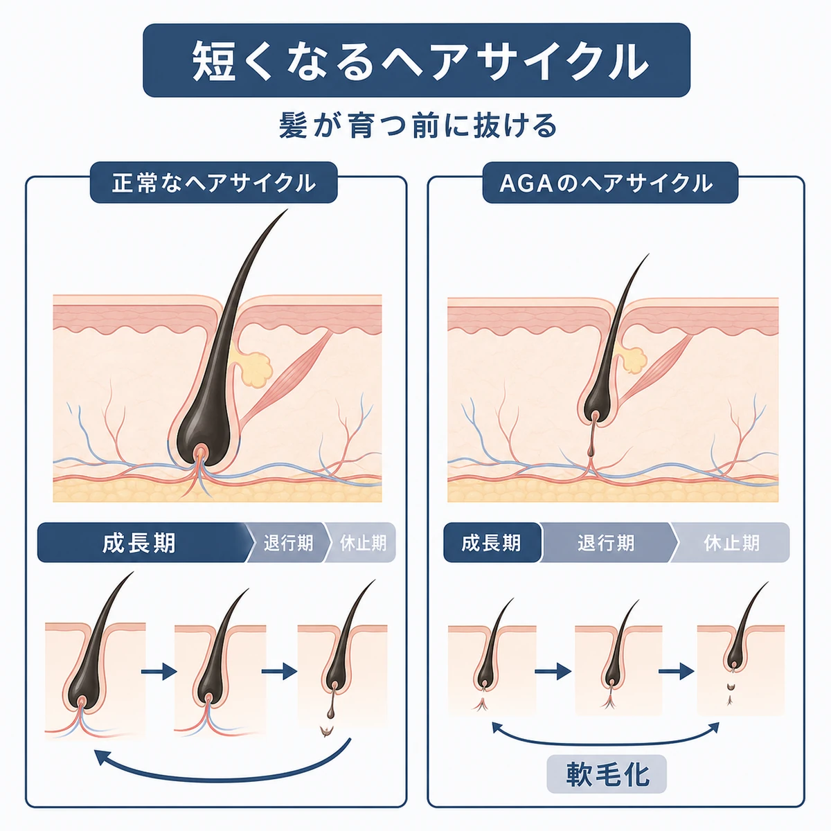 正常なヘアサイクルとAGAで短縮し髪が細くなったサイクルを比べた医療イラスト