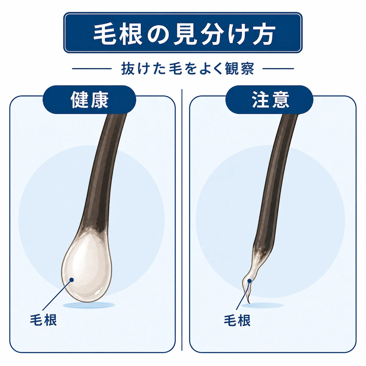 健康な毛根と注意したい毛根の形の違いを対比した医療イラスト