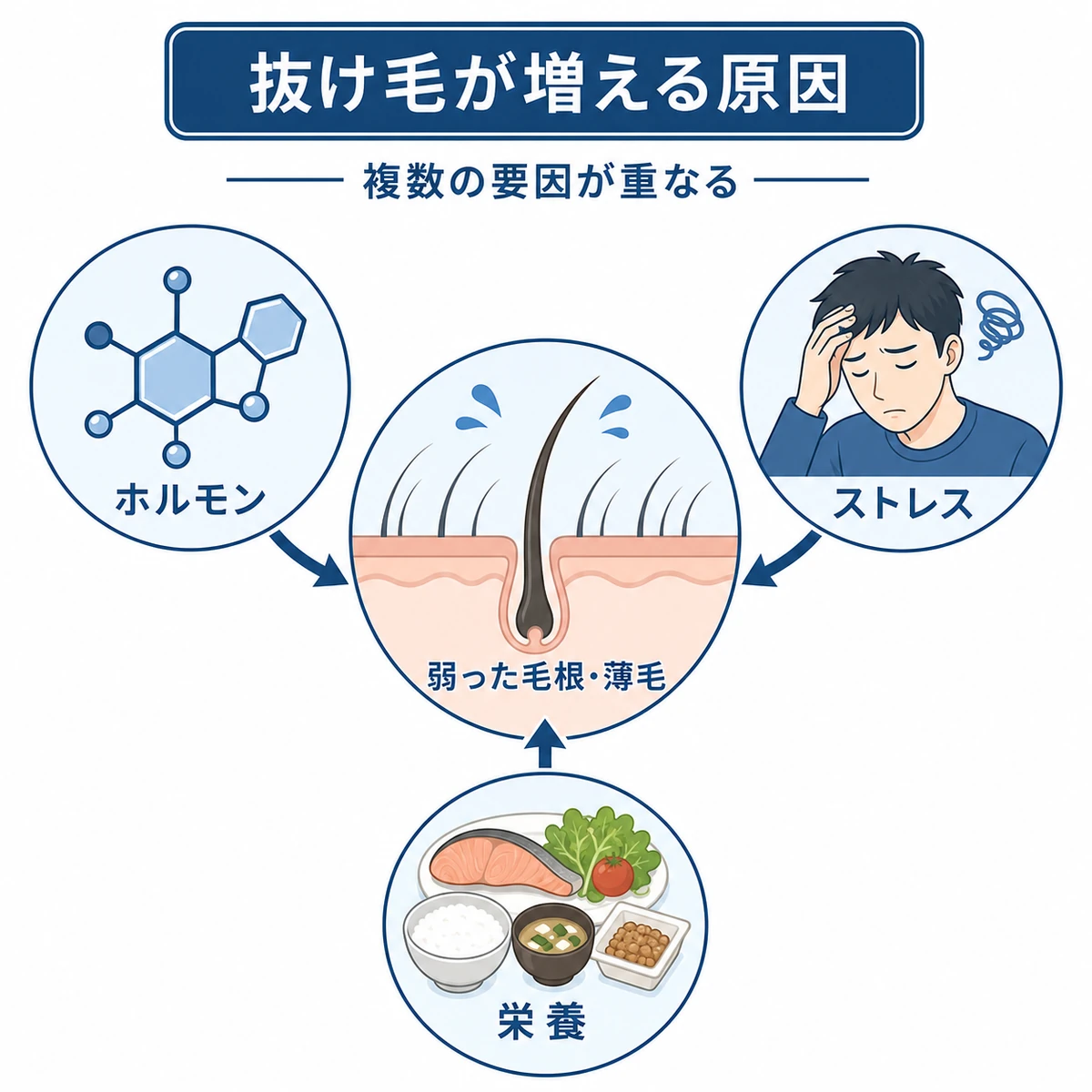 抜け毛を増やす主な原因の関係を矢印でつないだ医療イラスト
