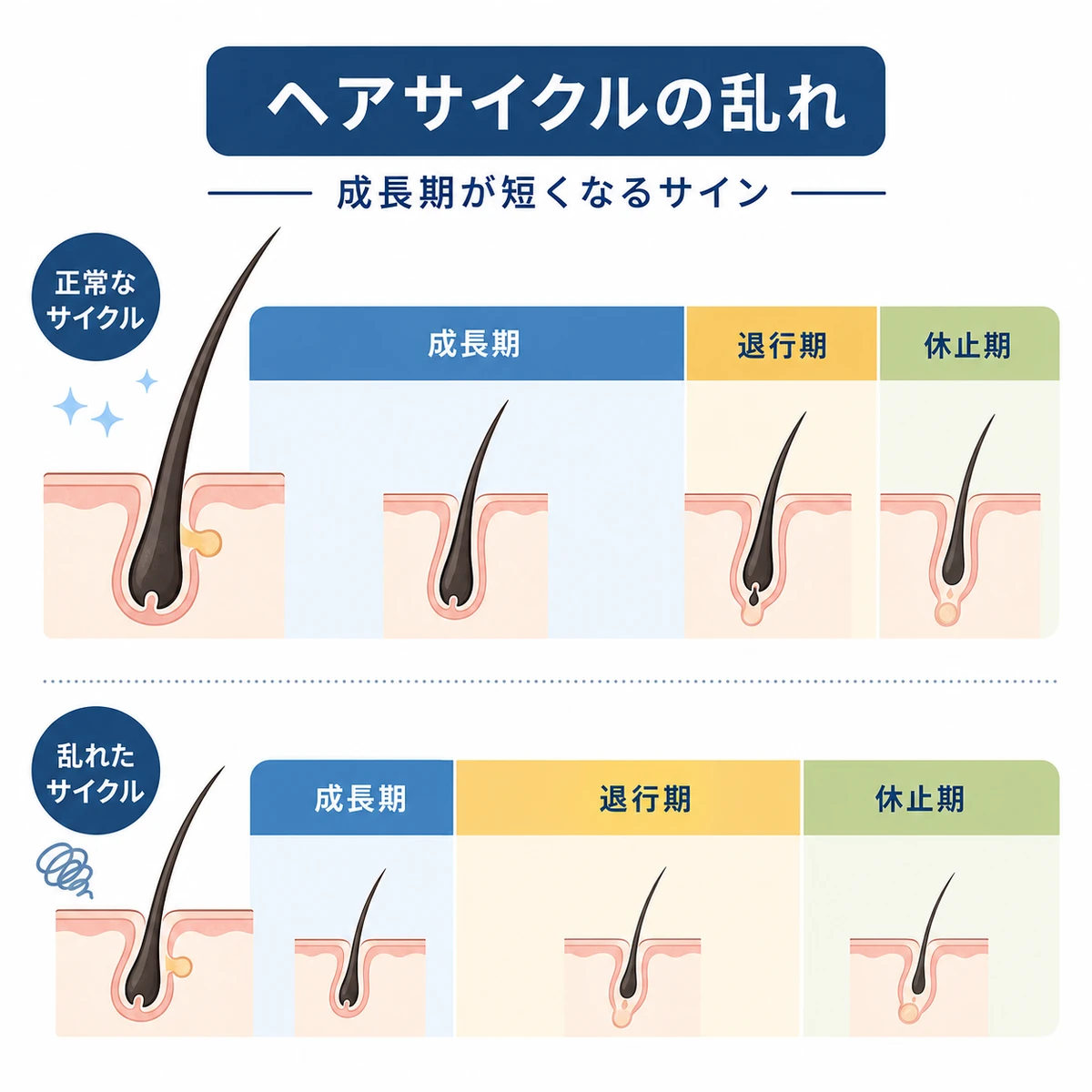 正常なヘアサイクルと成長期が短縮した状態を上下で比べた医療イラスト