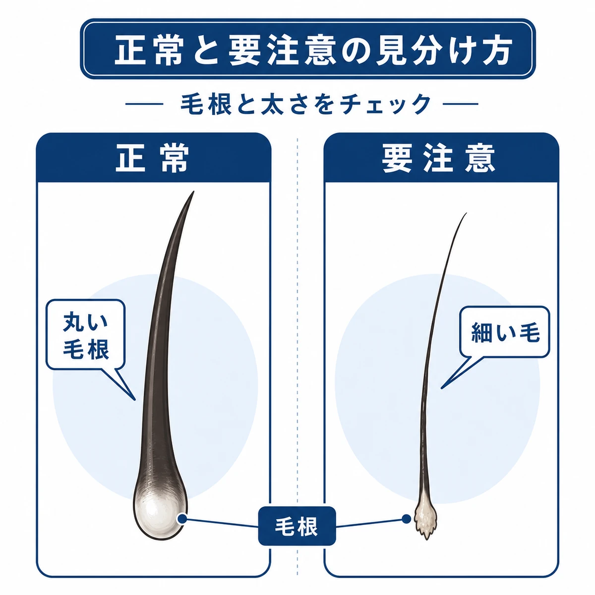 正常な毛根と要注意な細い抜け毛を左右で見比べた医療イラスト