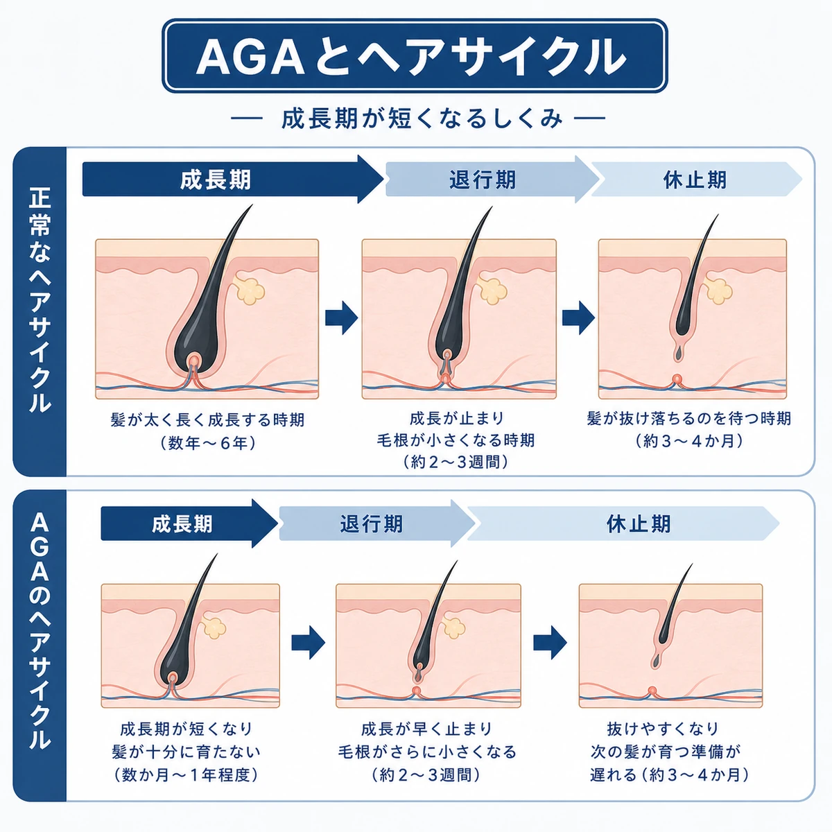 正常なヘアサイクルとAGAで成長期が短くなる流れを上下で比べた医療イラスト