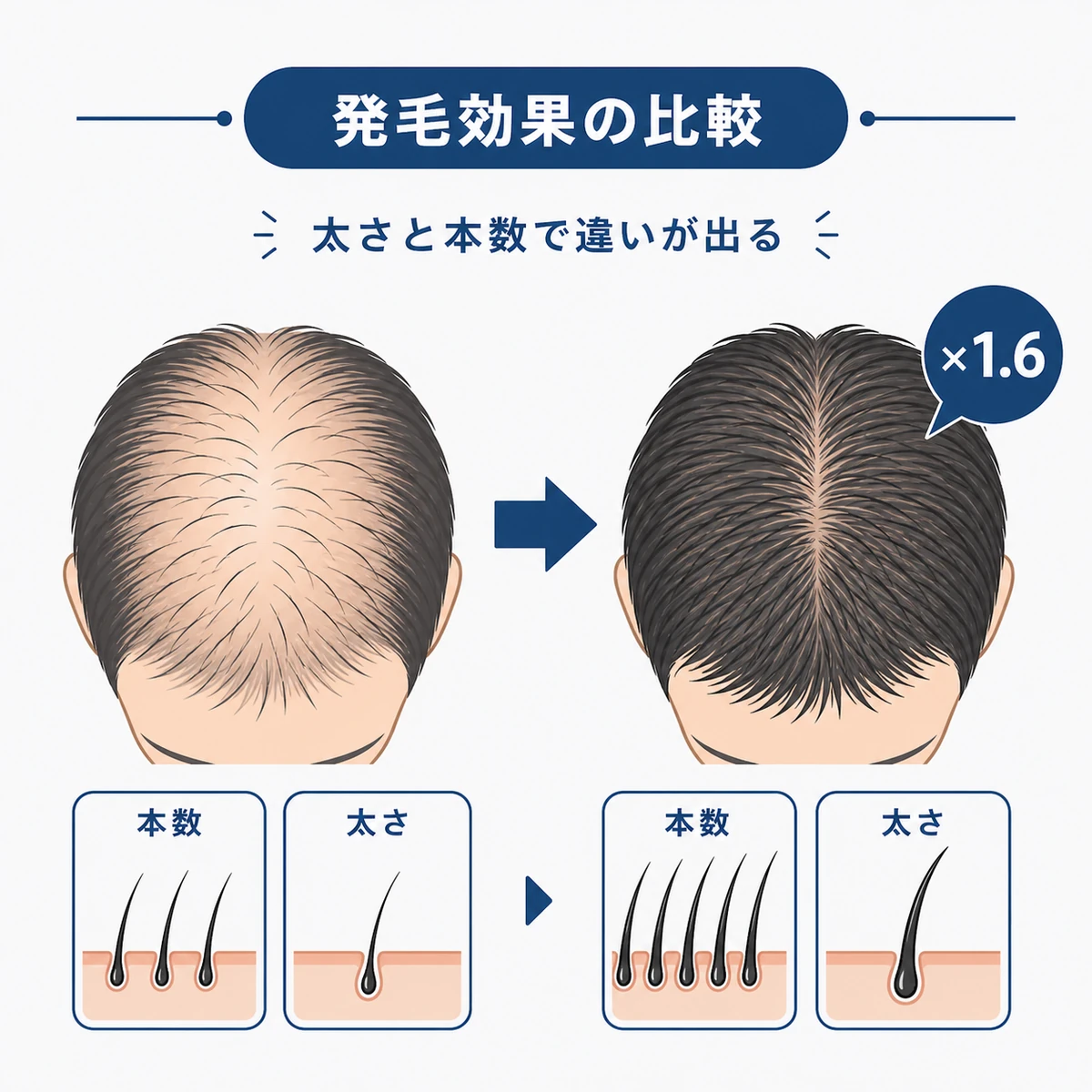 治療薬ごとの発毛効果の差を比べた医療イラスト
