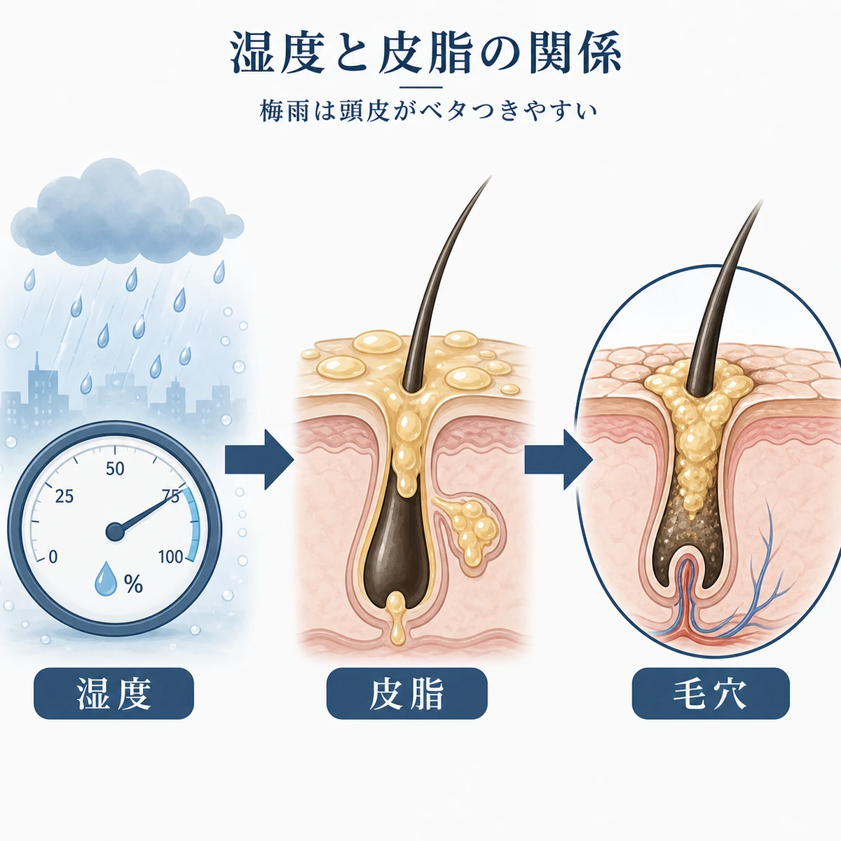 梅雨の湿気で皮脂が増え毛穴が詰まっていく流れを表した医療イラスト