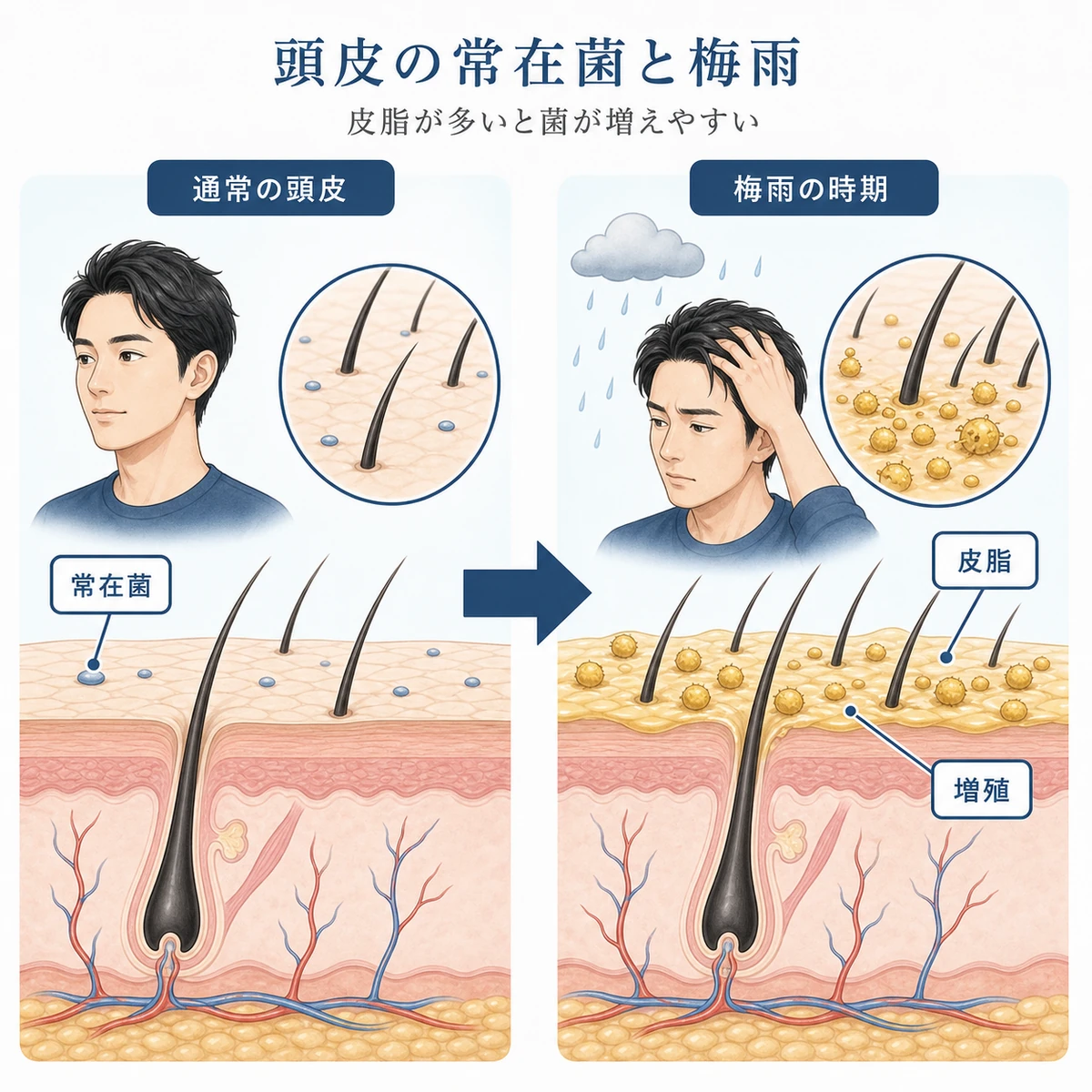 梅雨にマラセチア菌が皮脂を栄養に増える頭皮の変化を表した医療イラスト