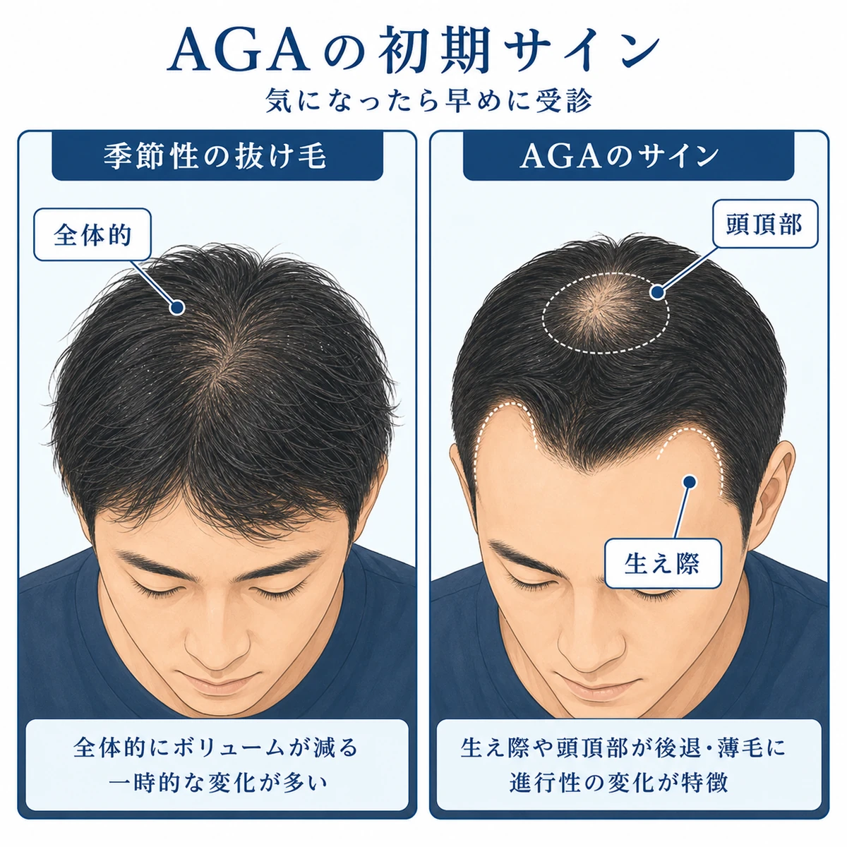 季節性の抜け毛とAGAの薄毛パターンの違いを表した医療イラスト