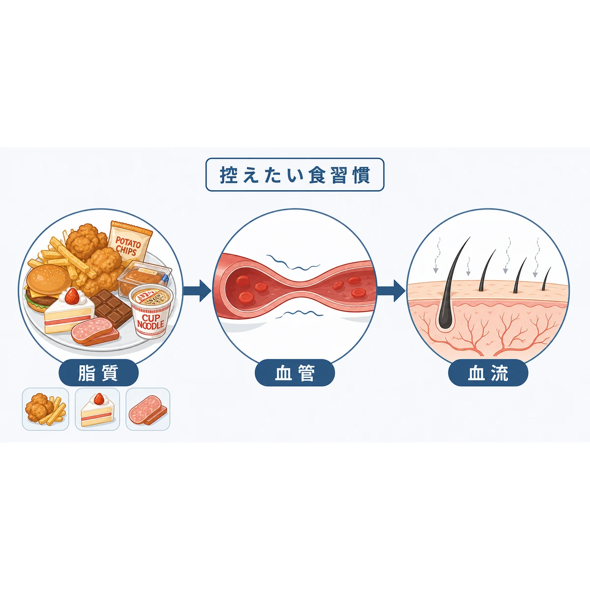 脂質や塩分の多い食習慣が頭皮の血流を下げていく流れを表した医療イラスト