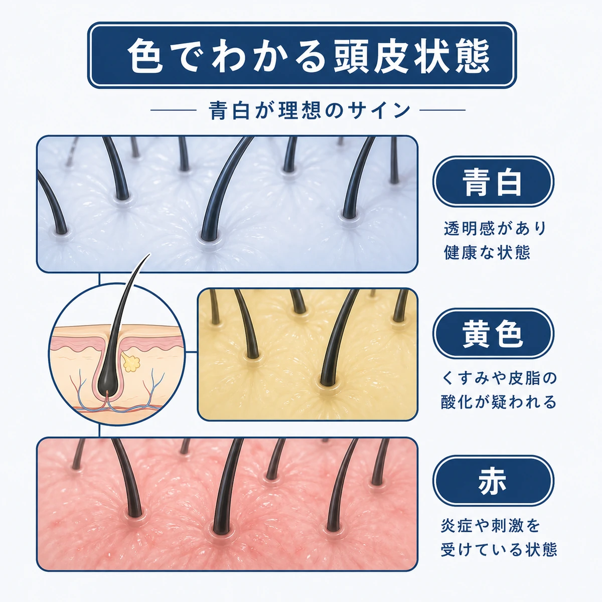 頭皮の色を青白・黄色・赤の3段階で見分ける健康チェックを表した医療イラスト