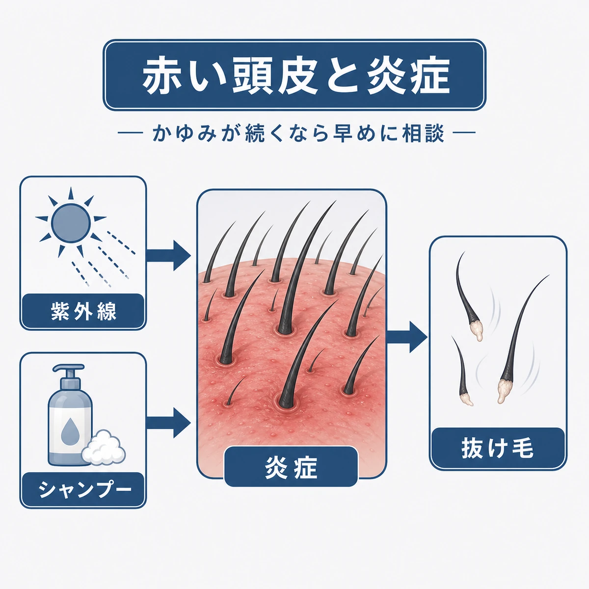 紫外線や刺激による頭皮の炎症から抜け毛へつながる流れを描いた医療イラスト