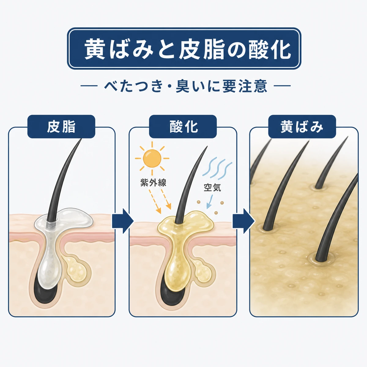 皮脂が酸化して頭皮が黄色くくすむまでの段階を示した医療イラスト