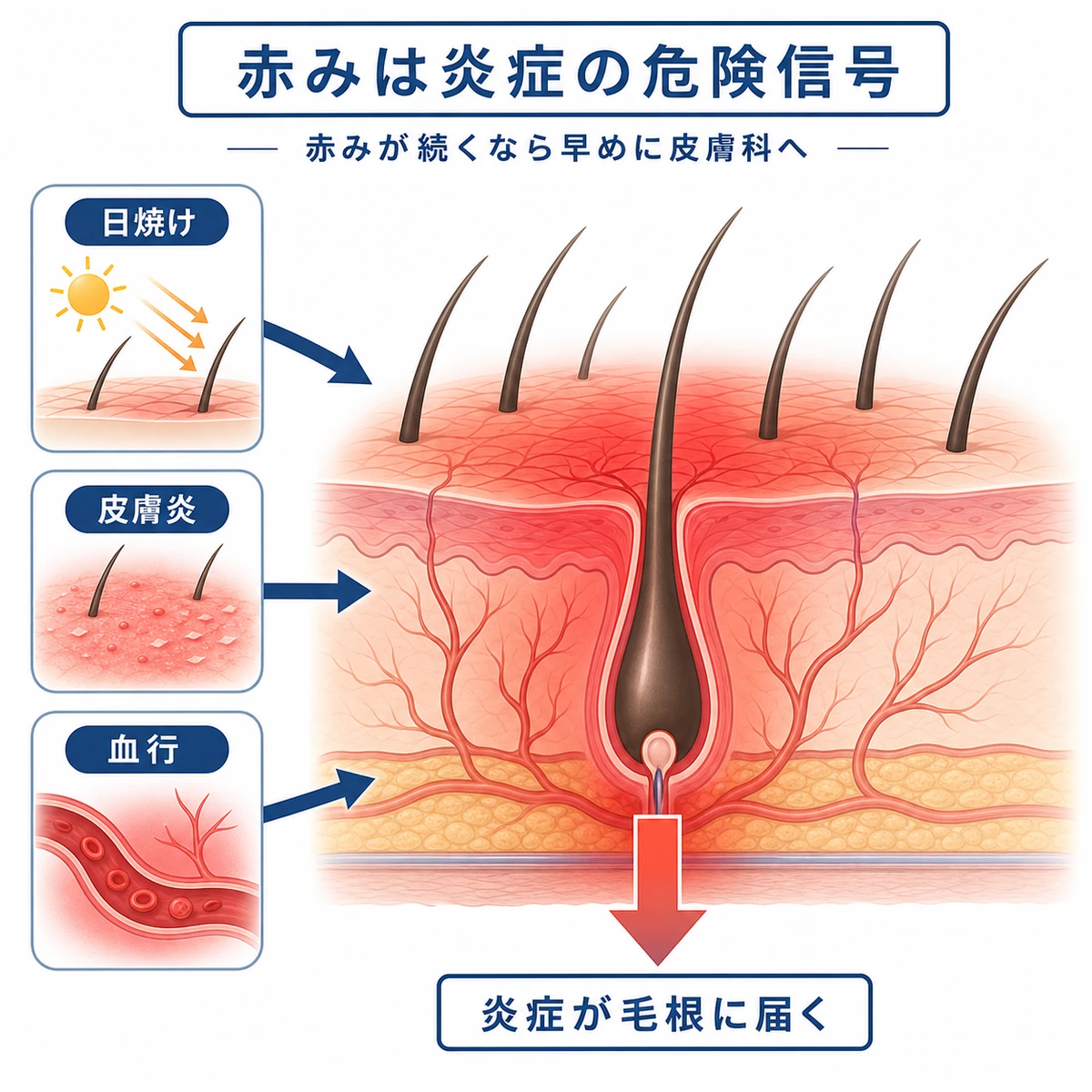 赤い頭皮の三つの原因が毛根の炎症につながる流れを示した医療イラスト