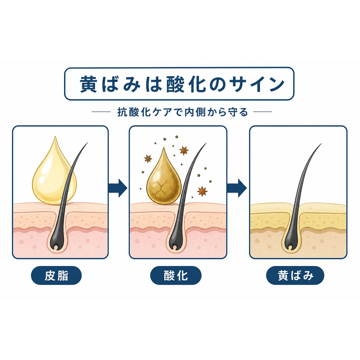 皮脂が酸化して頭皮が黄色くくすむまでの流れを表した医療イラスト