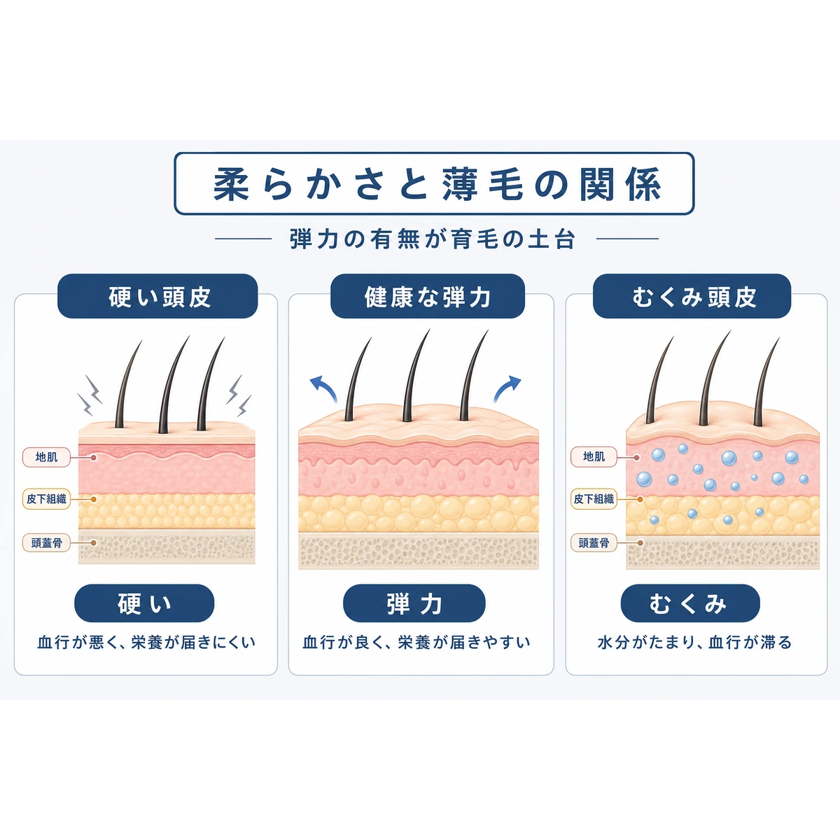 頭皮の硬さ・健康な弾力・むくみという三つの状態を並べて比べた断面の医療イラスト