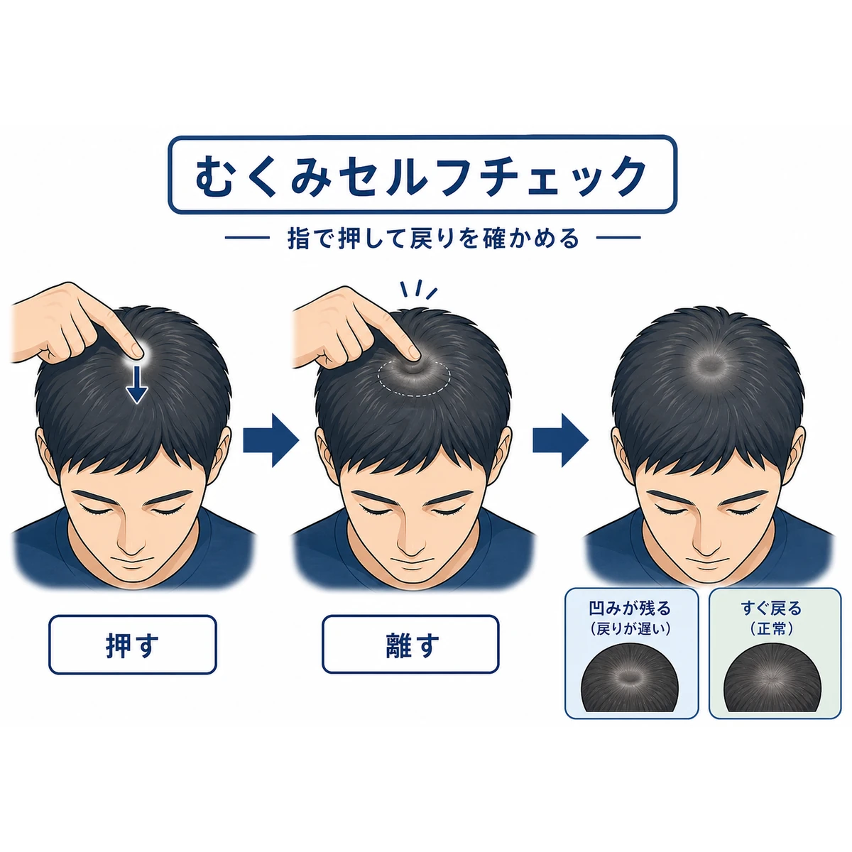 成人男性が指で頭皮を押して戻り具合を確かめるセルフチェックの手順を描いた医療イラスト