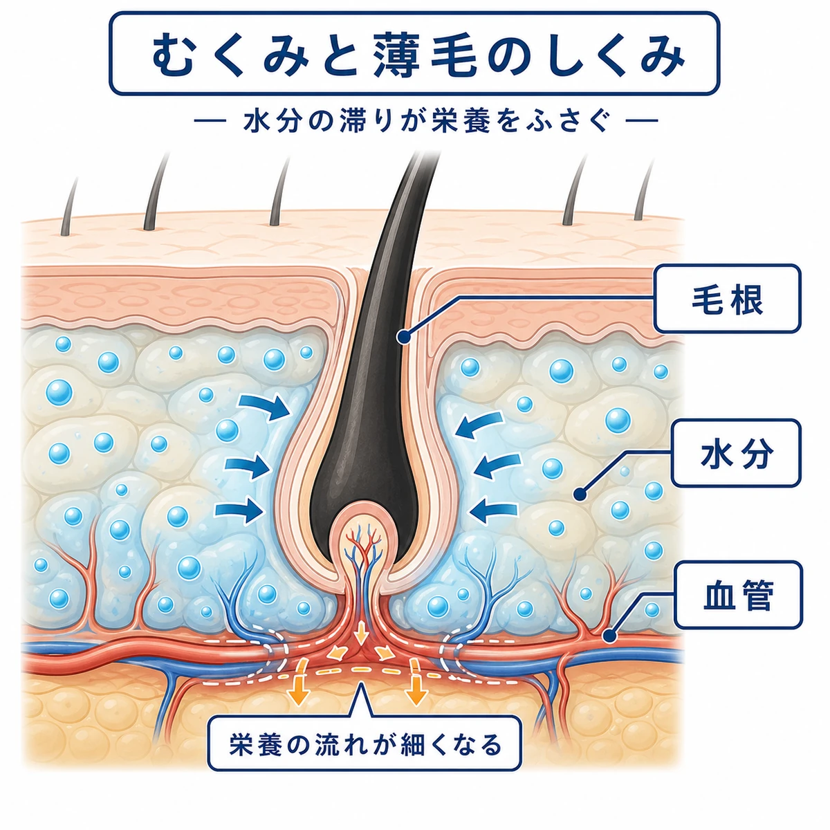 むくんだ頭皮の水分が毛根への血流をさまたげるしくみを描いた断面の医療イラスト