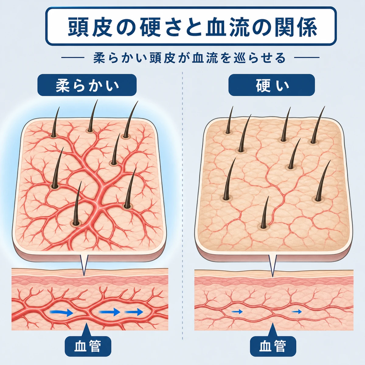 柔らかい頭皮と硬い頭皮で血管の巡りを比べた医療イラスト