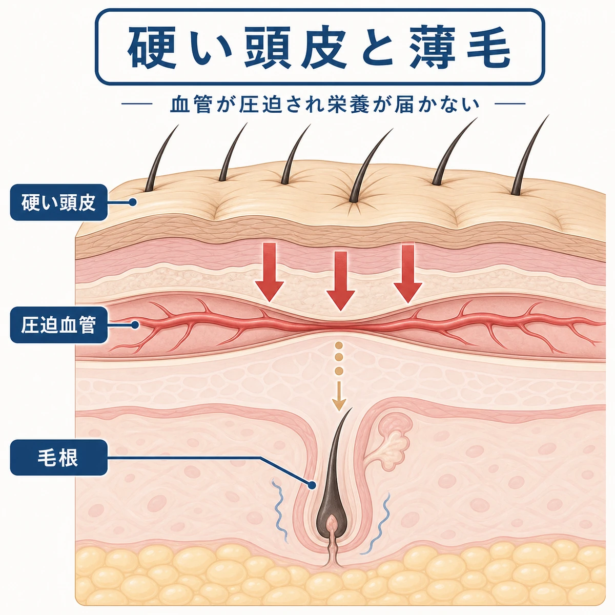 硬い頭皮が毛細血管を圧迫し毛根への栄養供給が滞る様子を表した頭皮断面の医療イラスト