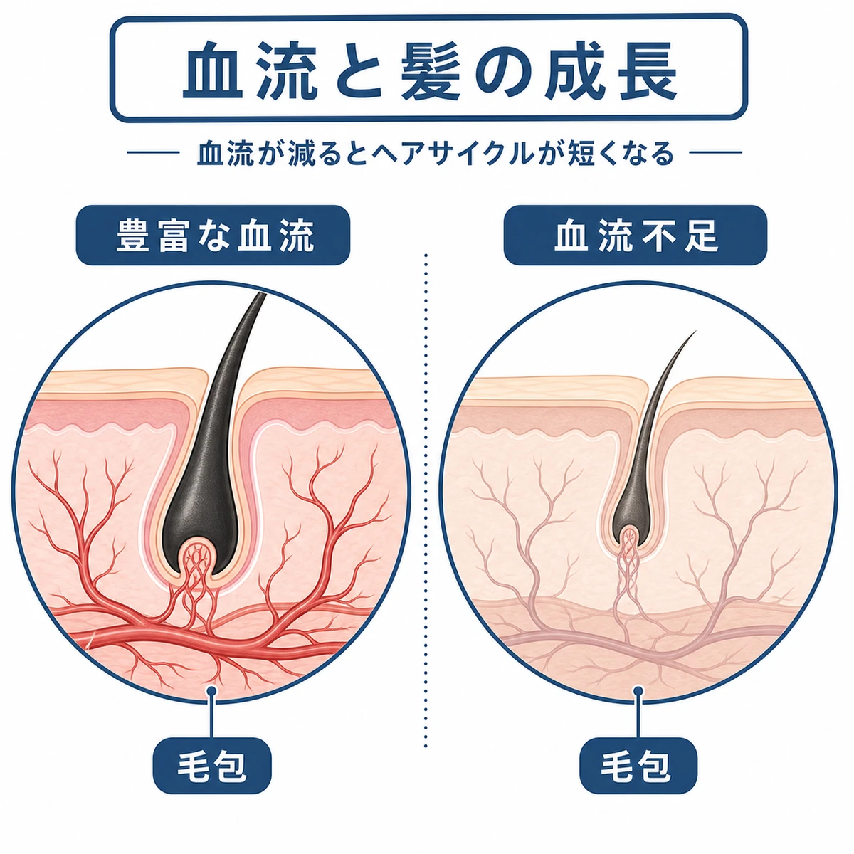 豊富な血流の毛包と血流不足で縮んだ毛包を左右で比較した医療イラスト