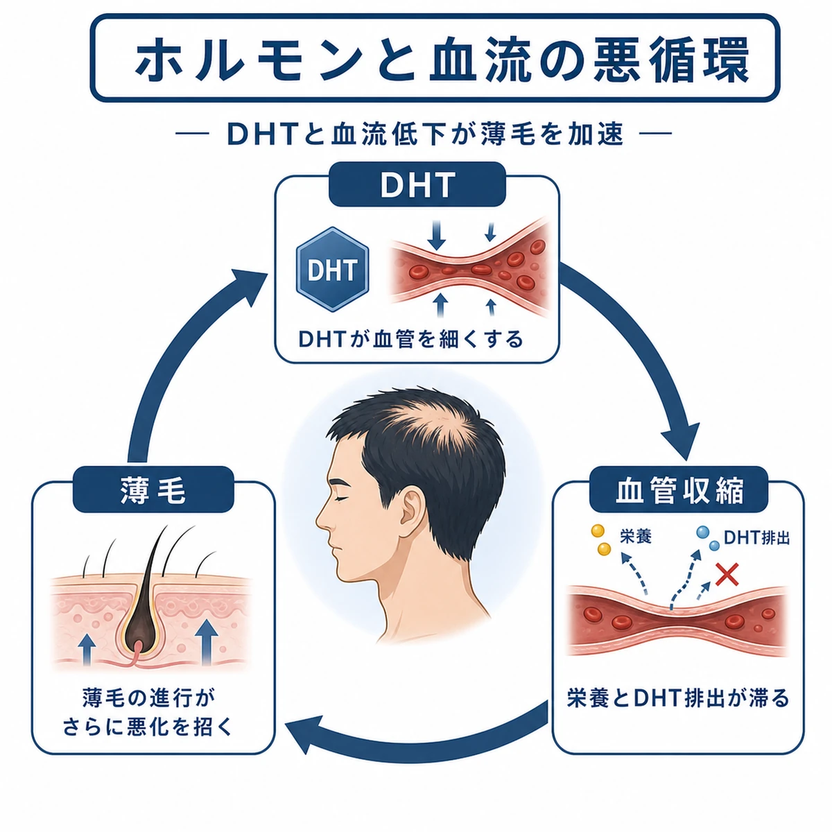 成人男性の頭部を中心に男性ホルモンDHTと血流低下が悪循環を作る仕組みを描いた医療イラスト