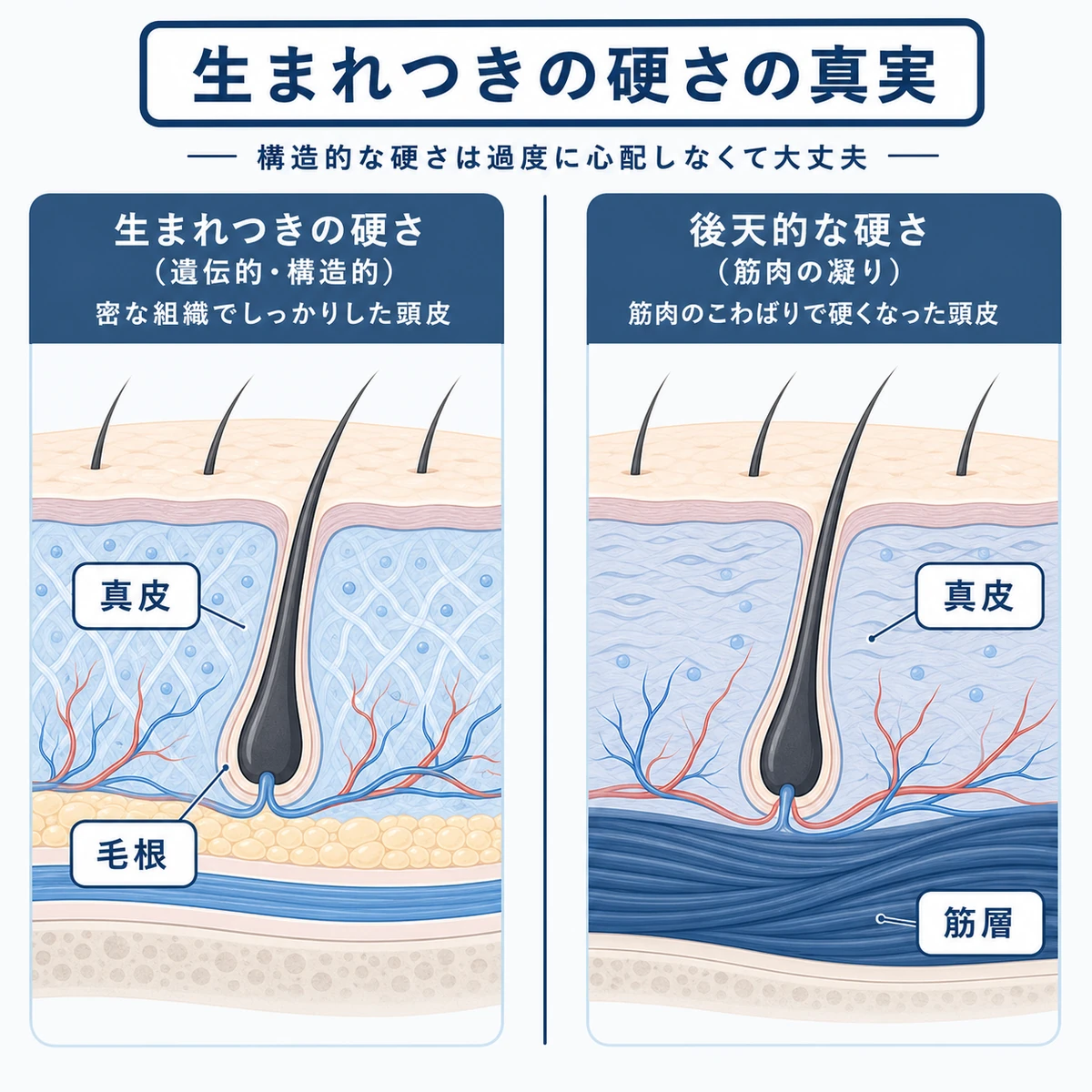 遺伝的な頭皮の硬さと筋肉の凝りによる硬さの違いを比べた頭皮断面の医療イラスト