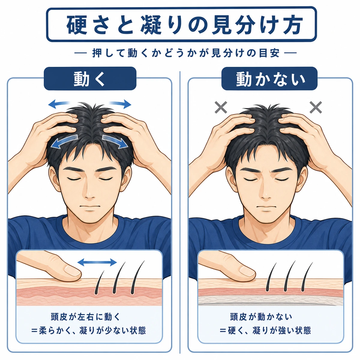 成人男性が指で頭皮の動きを確かめてセルフチェックする様子を描いた医療イラスト