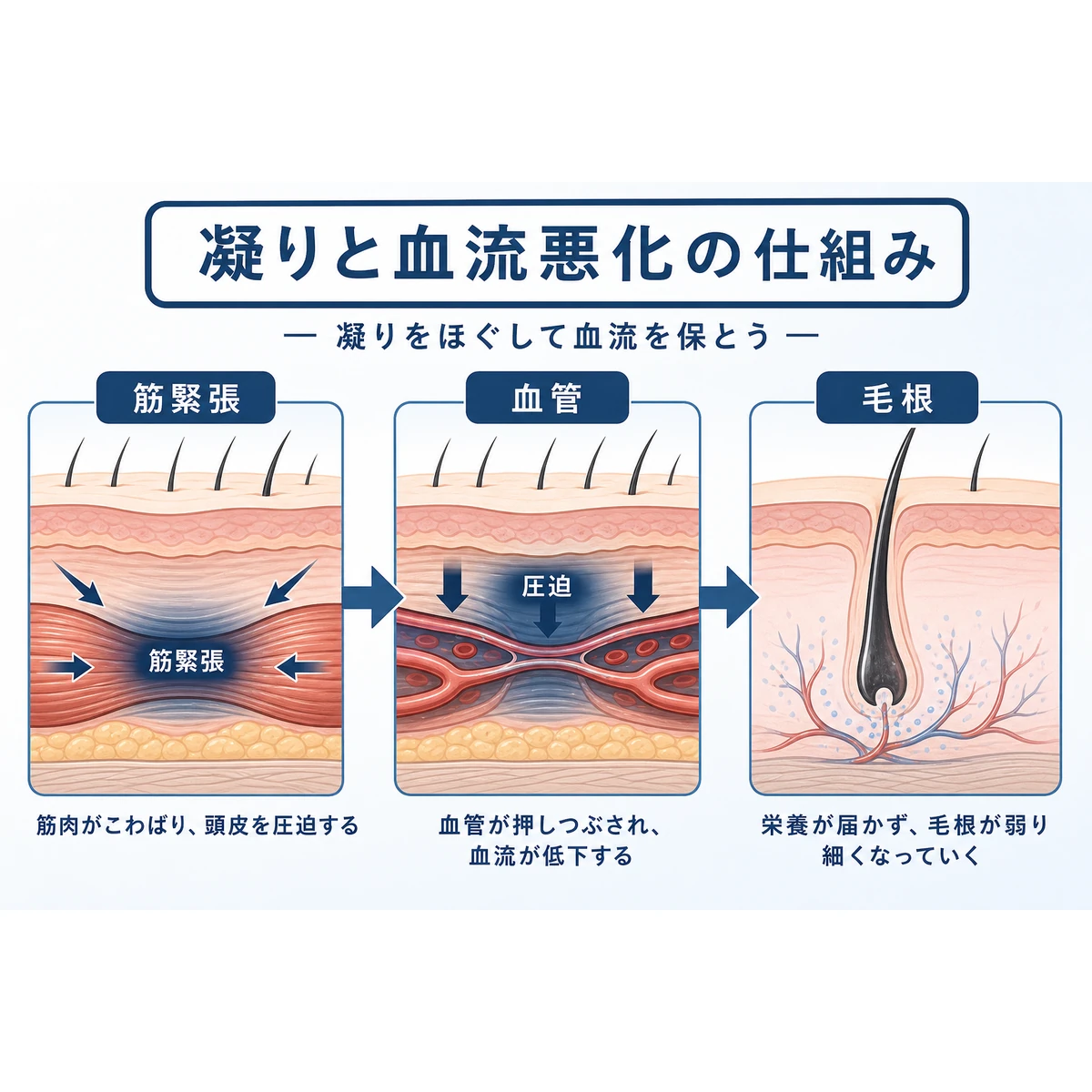 頭皮の凝りで毛細血管が圧迫され毛根に栄養が届きにくくなる流れを描いた医療イラスト