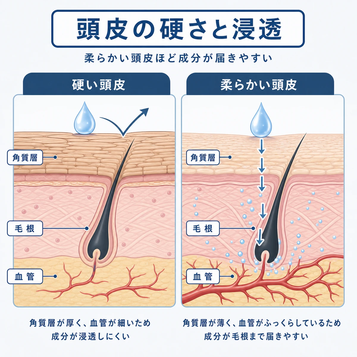 硬い頭皮と柔らかい頭皮で育毛剤の浸透の差を比べた断面図の医療イラスト