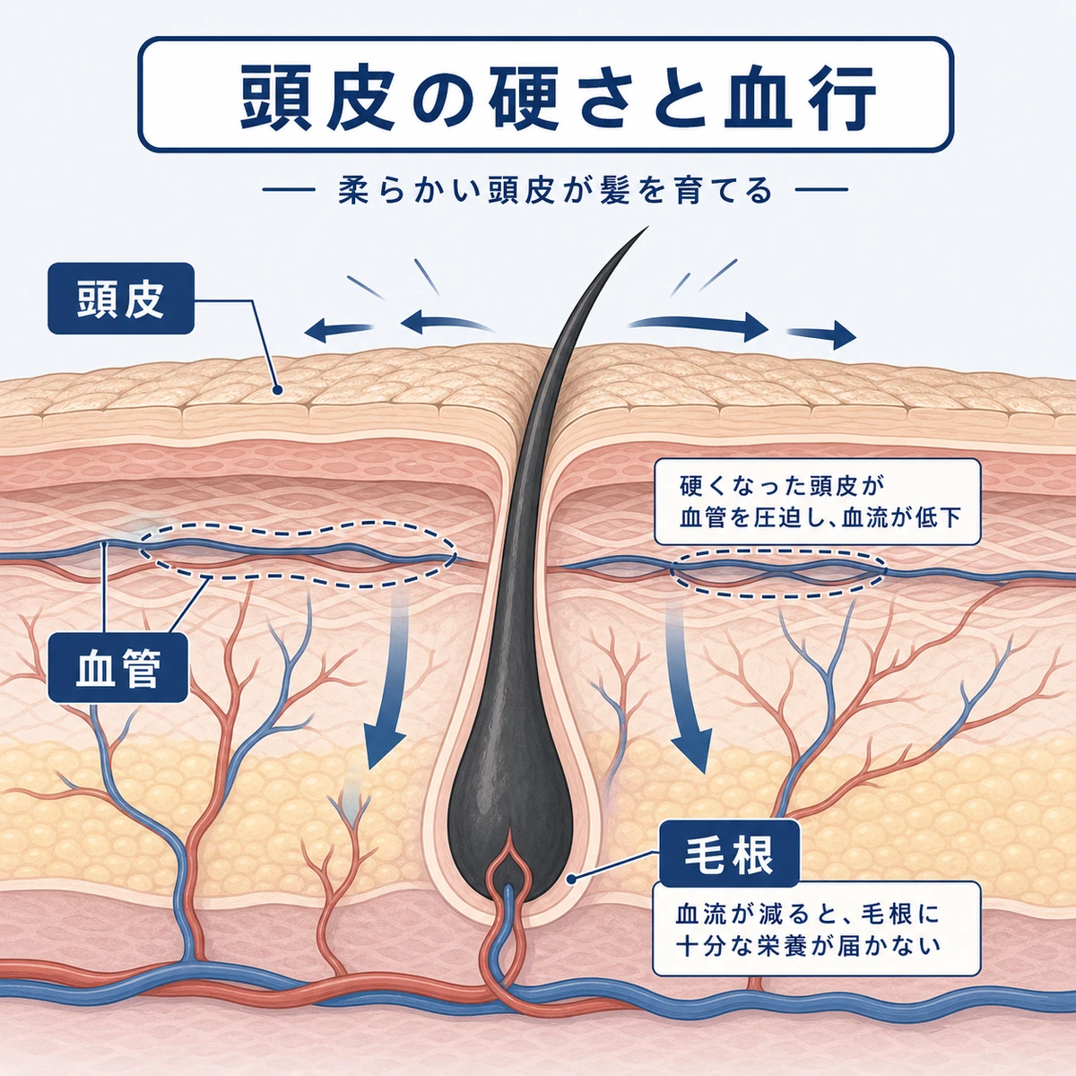 硬くなった頭皮で毛細血管が圧迫され毛根への血流が減る仕組みを表した医療イラスト