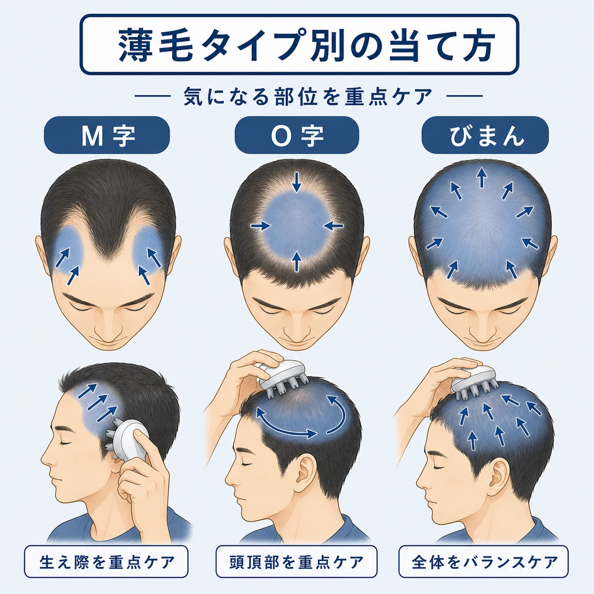 M字型O字型びまん型それぞれに合わせた頭皮マッサージ器の当て方を表した解説イラスト