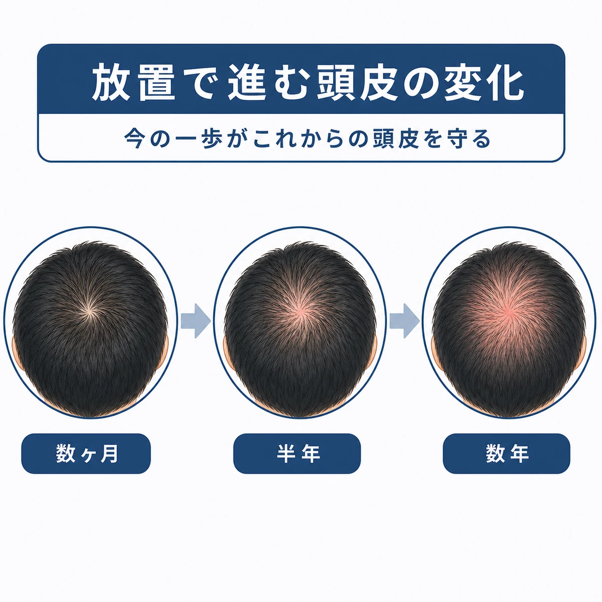 赤みを放置した頭皮の状態が時間とともに変化する様子を表した医療イラスト
