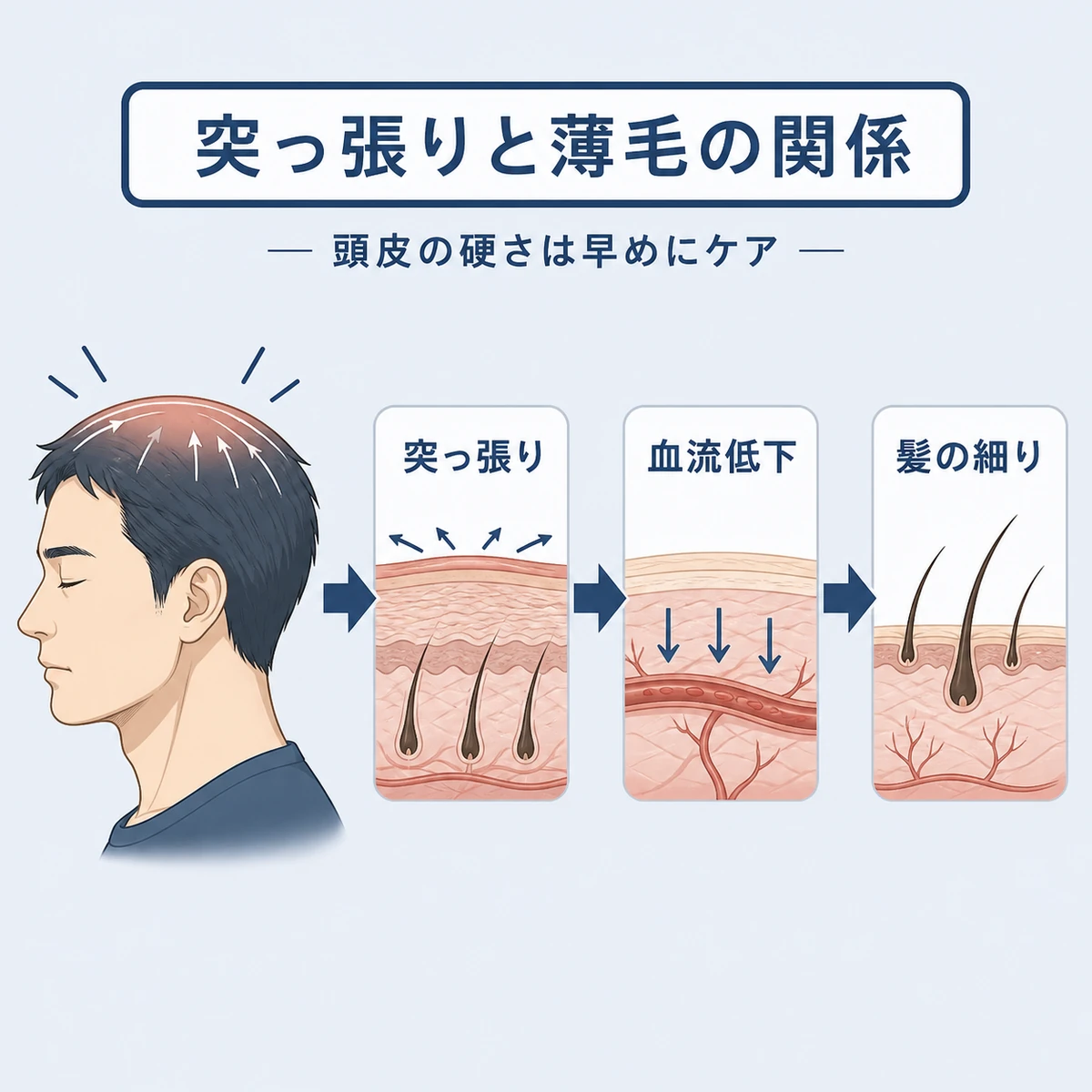 頭頂部の突っ張りから血流低下を経て髪が細くなる流れを表した医療イラスト