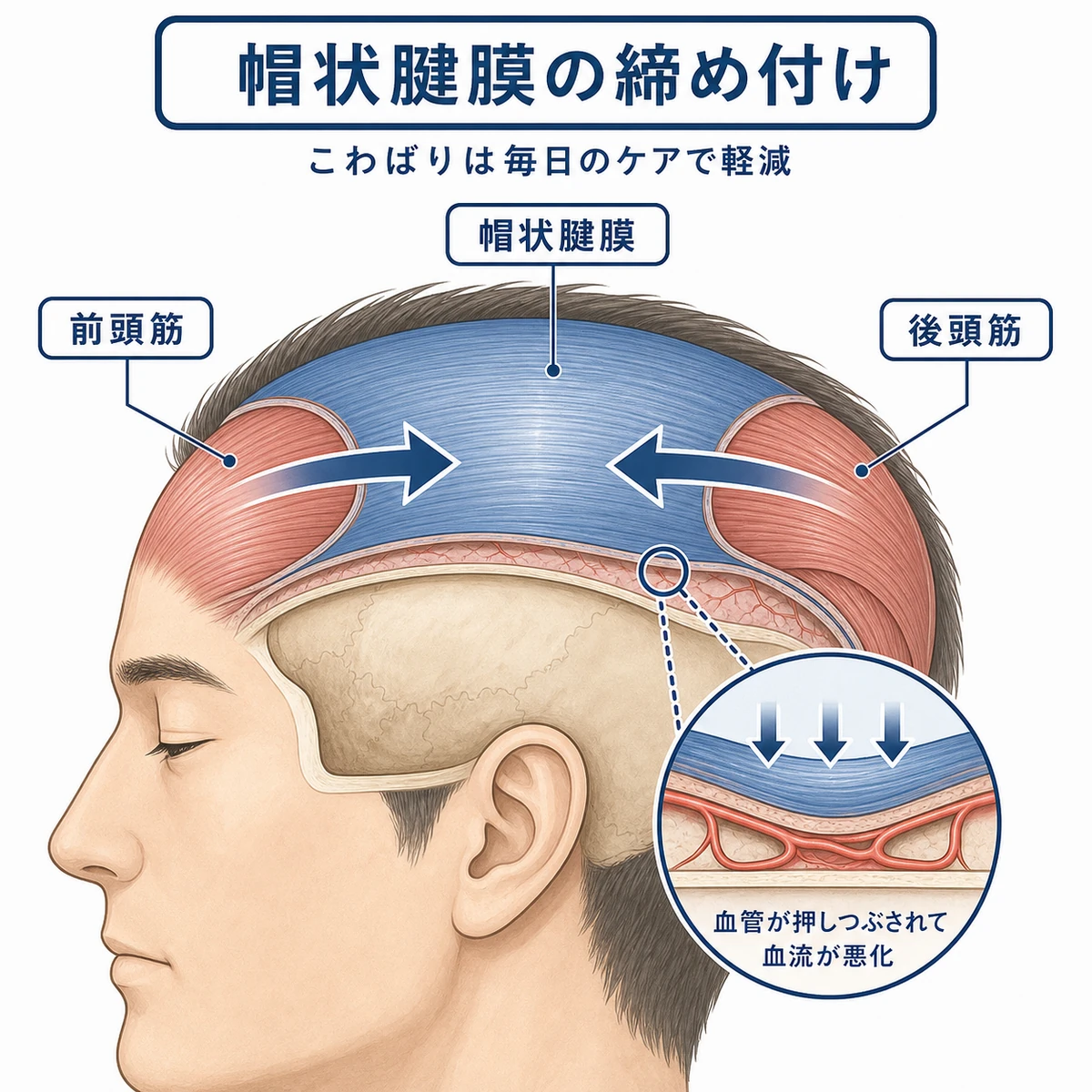 帽状腱膜が周囲の筋肉に引っ張られて血管を押しつぶす仕組みを示した頭部の断面イラスト