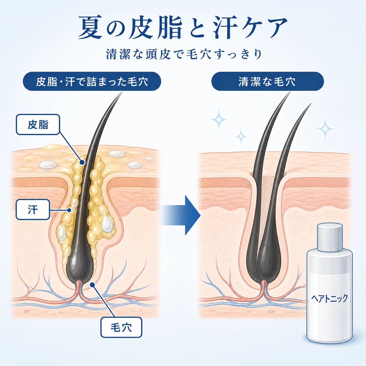 夏に皮脂と汗で毛穴が詰まる仕組みと皮脂コントロールを示した医療イラスト