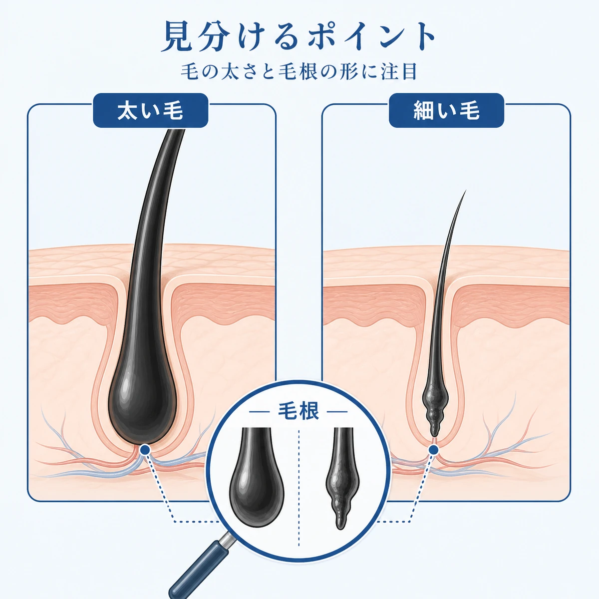健康な太い毛とAGAで細くなった毛の違いを毛根の形で比べた医療イラスト