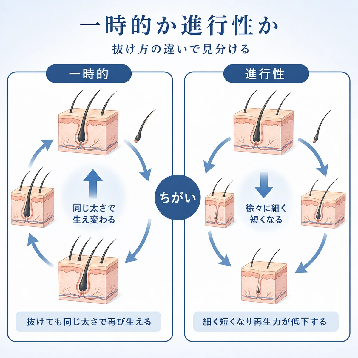 季節性の抜け毛とAGAで髪の生え変わり方が異なる様子を左右で対比した医療イラスト