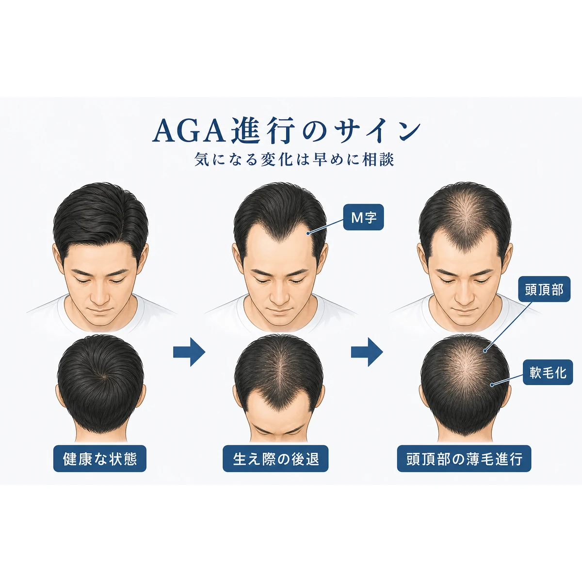 成人男性の生え際と頭頂部が段階的に変化していくAGA進行のサインを示した医療イラスト