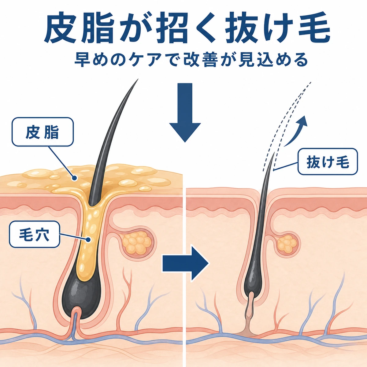 頭皮の皮脂過剰が毛穴の詰まりと抜け毛につながる仕組みを表した頭皮断面の医療イラスト