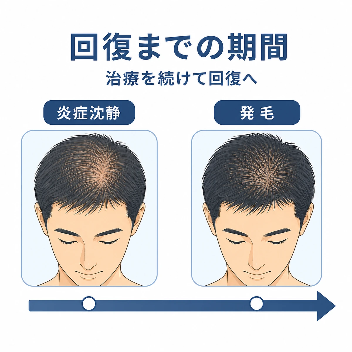 成人男性の頭皮が炎症の沈静から発毛へと回復していく経過を時間軸で表した医療イラスト