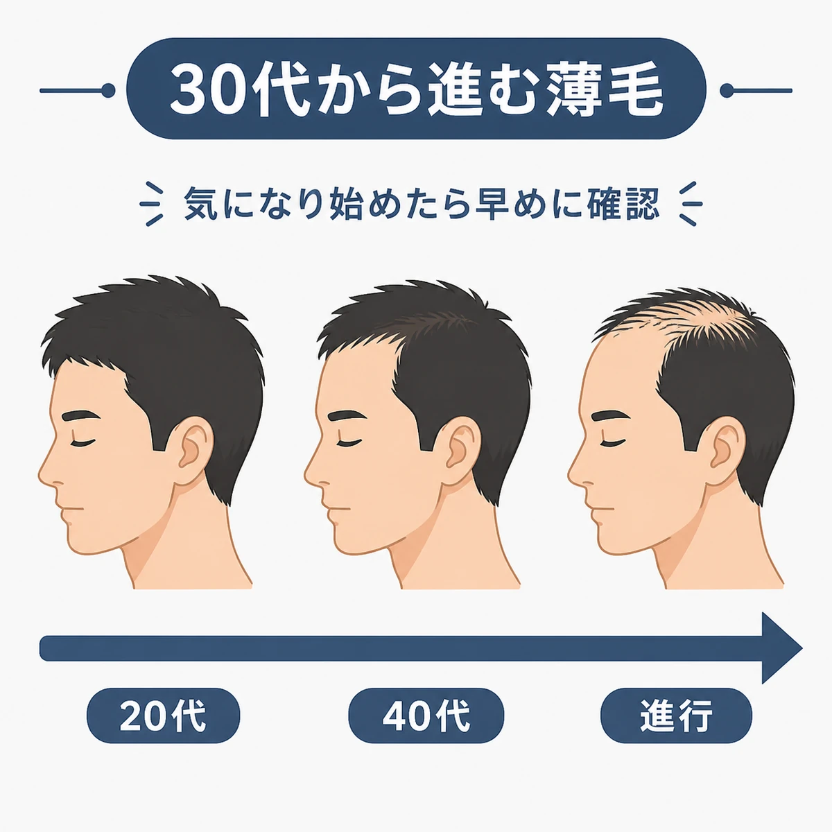 年代を追って壮年性脱毛症が進行していく様子を表した医療イラスト