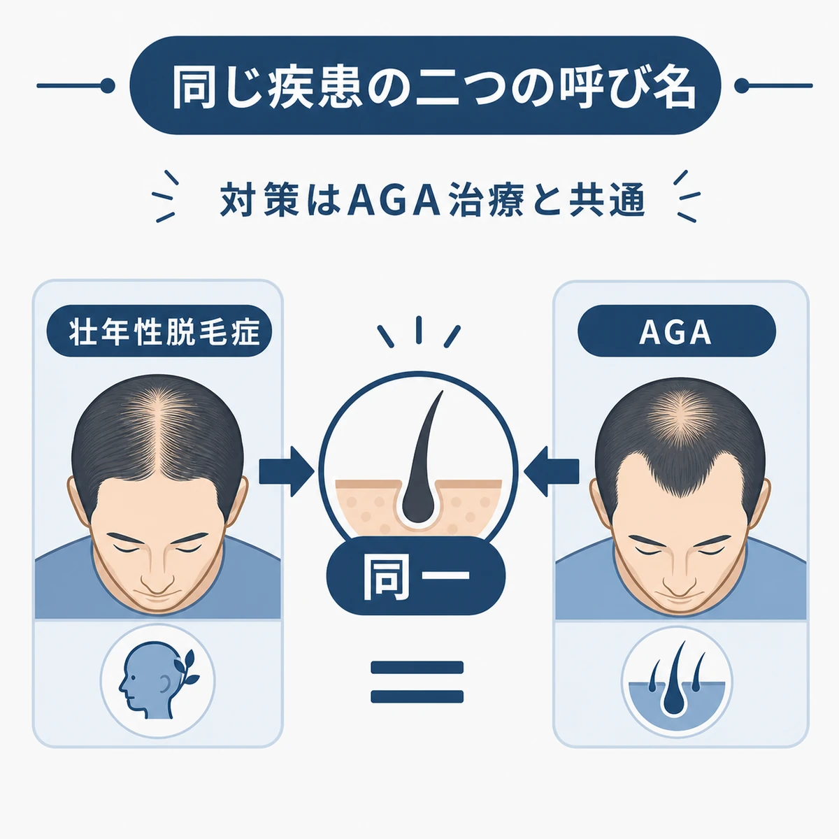 壮年性脱毛症とAGAが同じ疾患であることを表した医療イラスト