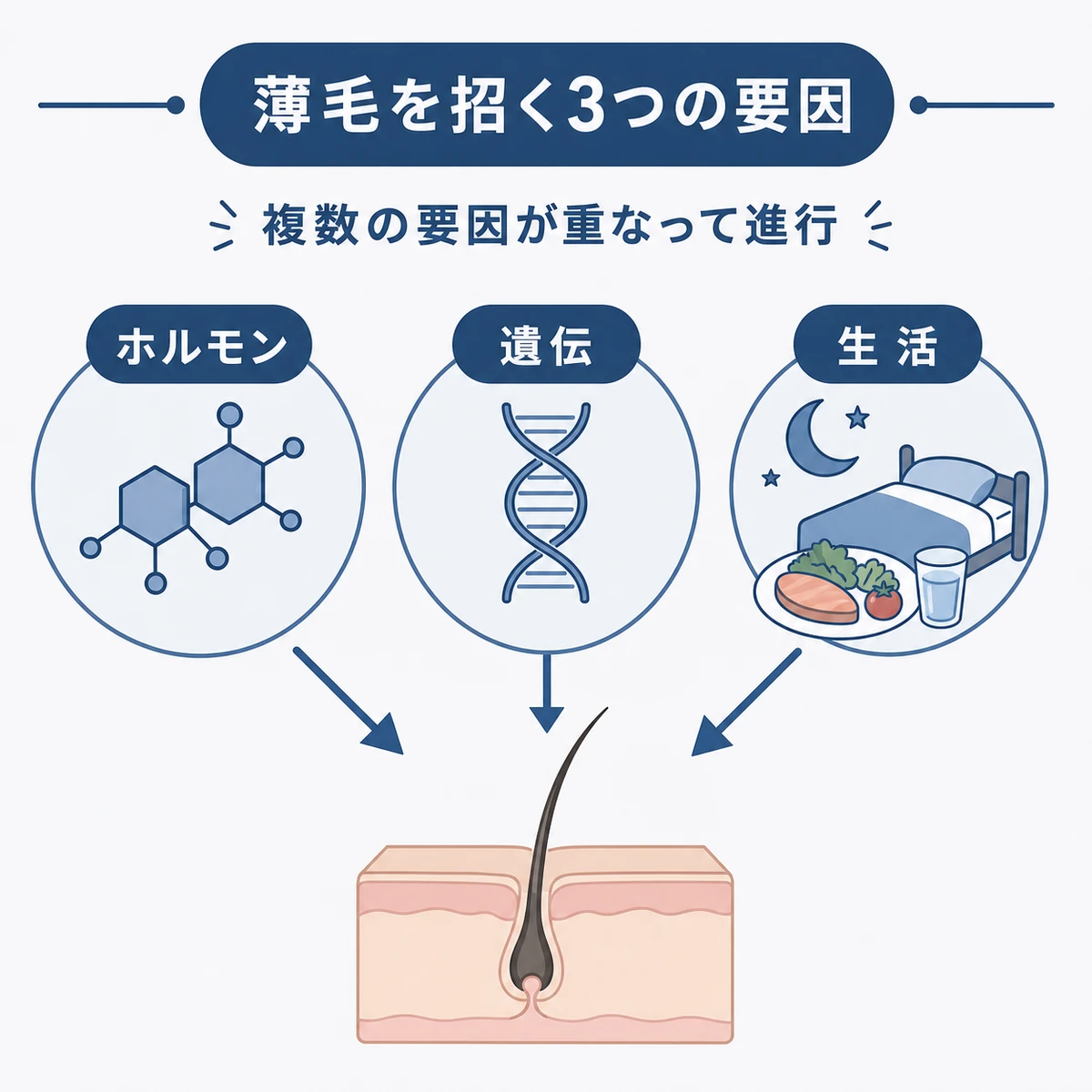 ホルモン・遺伝・生活習慣の3要因が薄毛に関わる仕組みを表した医療イラスト