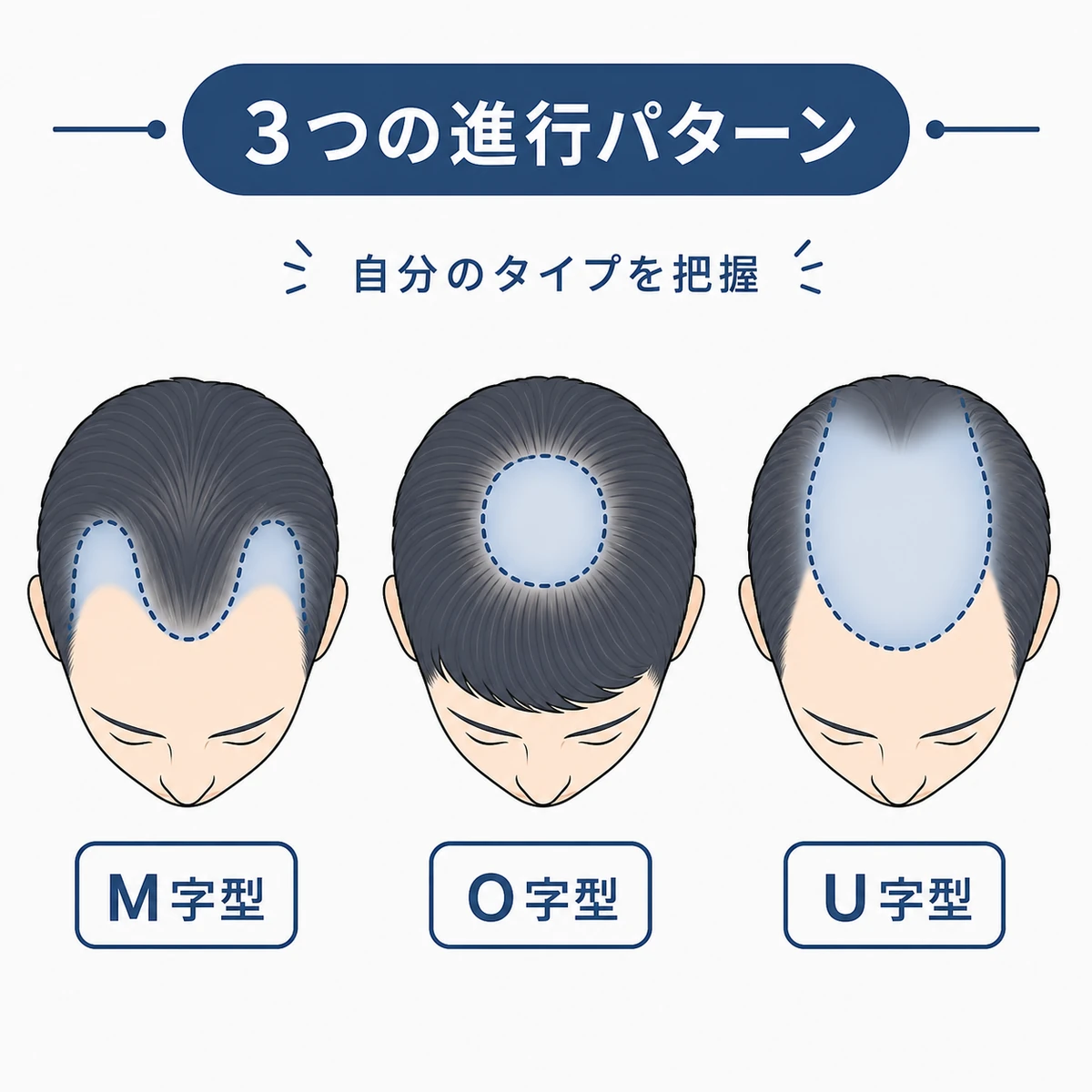 M字・O字・U字の進行パターンを頭頂部の形で比べた医療イラスト