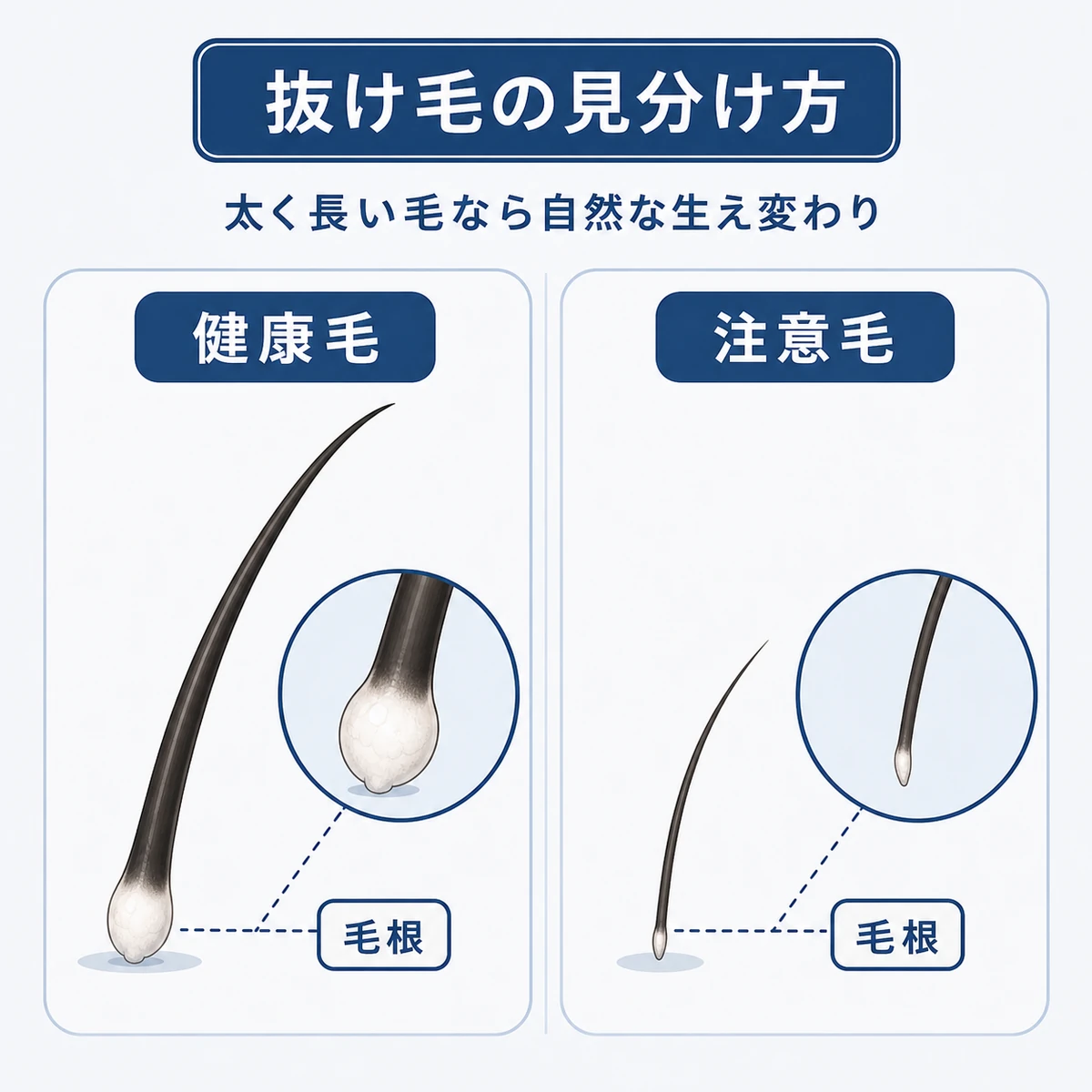 健康な抜け毛と注意したい細い抜け毛を毛根の形で比べた医療イラスト